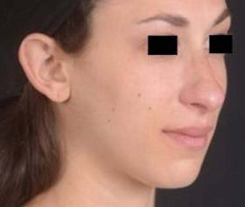 Rhinoplasty Before & After Gallery - Patient 111055 - Image 9