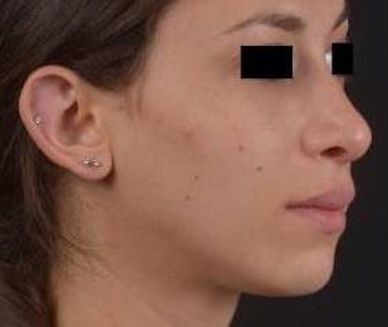 Rhinoplasty Before & After Gallery - Patient 111055 - Image 10