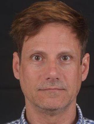 Rhinoplasty Before & After Gallery - Patient 361178 - Image 2