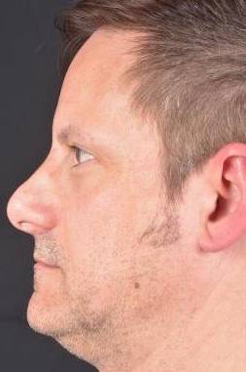 Rhinoplasty Before & After Gallery - Patient 361178 - Image 3