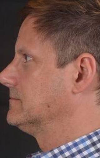 Rhinoplasty Before & After Gallery - Patient 361178 - Image 4