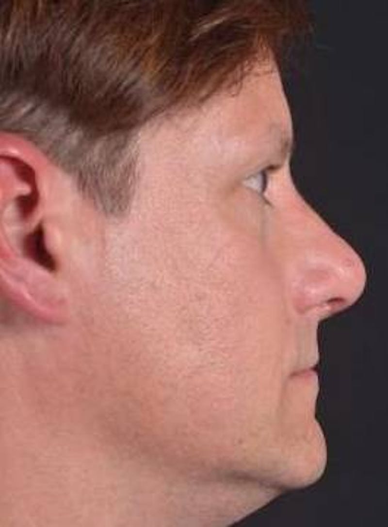 Rhinoplasty Before & After Gallery - Patient 361178 - Image 5
