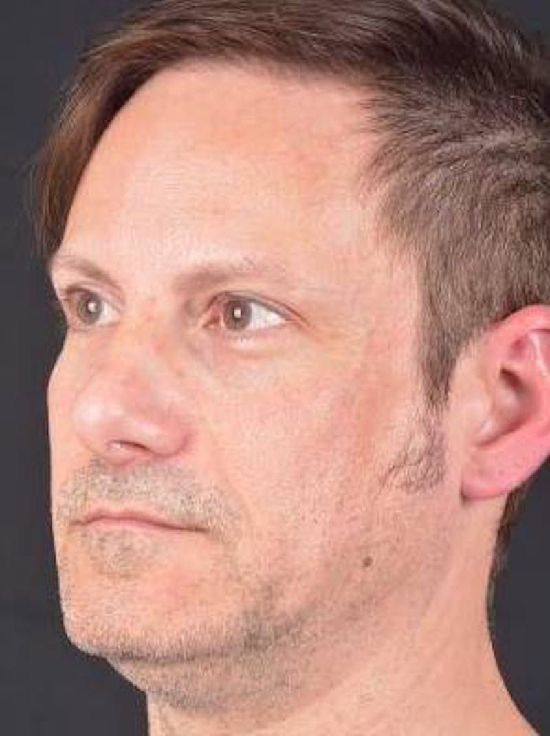 Rhinoplasty Before & After Gallery - Patient 361178 - Image 7