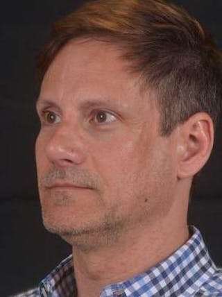 Rhinoplasty Before & After Gallery - Patient 361178 - Image 8