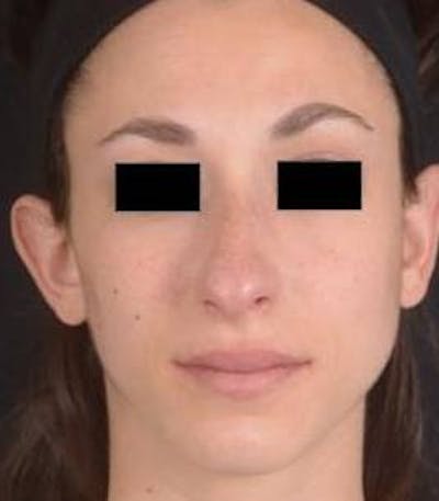 Rhinoplasty Before & After Gallery - Patient 111055 - Image 1