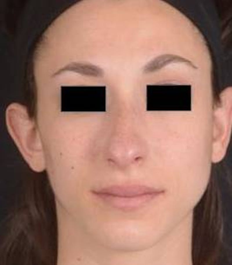 Rhinoplasty Before & After Gallery - Patient 111055 - Image 1