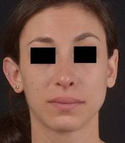 Rhinoplasty Before & After Gallery - Patient 111055 - Image 2