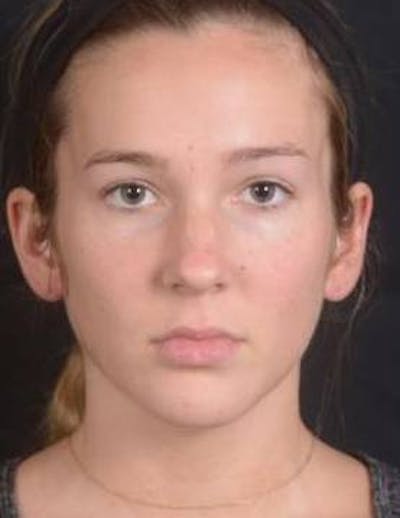 Rhinoplasty Before & After Gallery - Patient 230823 - Image 1