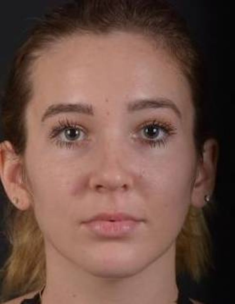 Rhinoplasty Before & After Gallery - Patient 230823 - Image 2