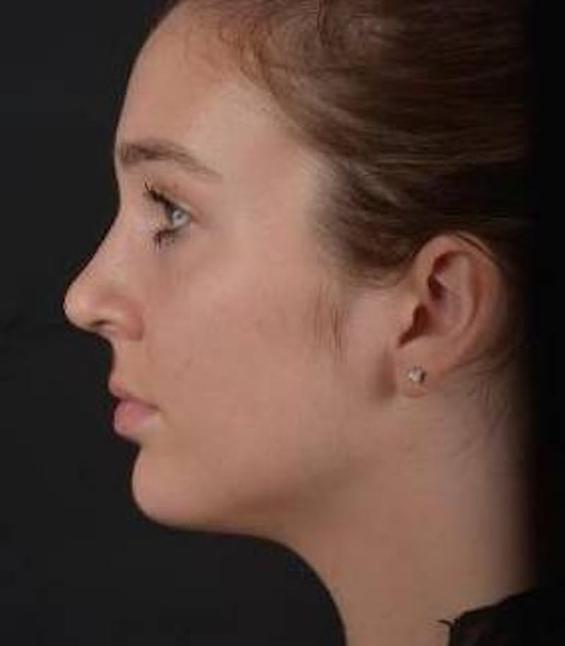Rhinoplasty Before & After Gallery - Patient 230823 - Image 4