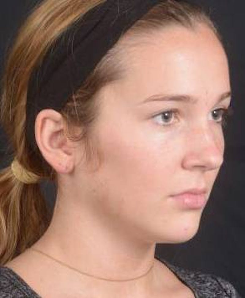 Rhinoplasty Before & After Gallery - Patient 230823 - Image 7