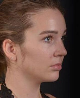 Rhinoplasty Before & After Gallery - Patient 230823 - Image 8