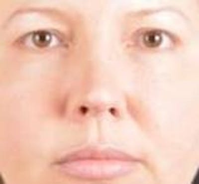 Rhinoplasty Before & After Gallery - Patient 483105 - Image 1