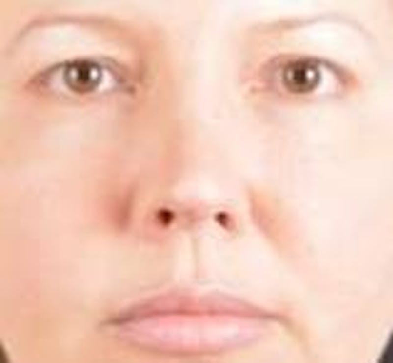 Rhinoplasty Before & After Gallery - Patient 483105 - Image 1