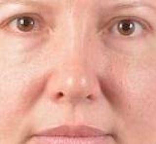 Rhinoplasty Before & After Gallery - Patient 483105 - Image 2