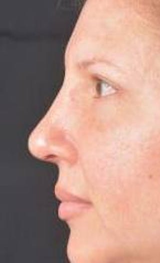 Rhinoplasty Before & After Gallery - Patient 483105 - Image 4