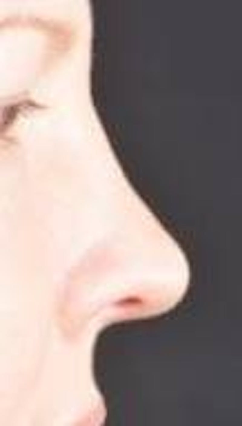 Rhinoplasty Before & After Gallery - Patient 483105 - Image 5