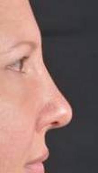 Rhinoplasty Before & After Gallery - Patient 483105 - Image 6