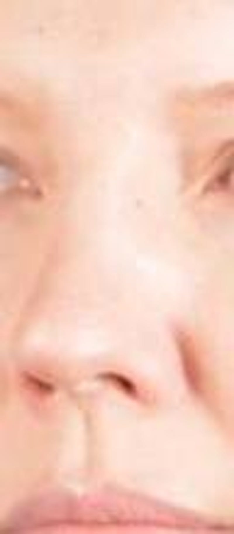 Rhinoplasty Before & After Gallery - Patient 483105 - Image 7