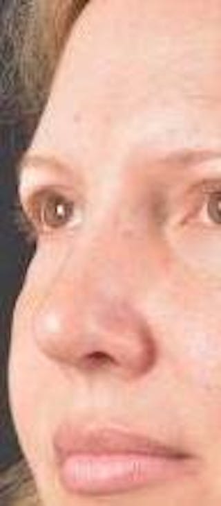 Rhinoplasty Before & After Gallery - Patient 483105 - Image 8