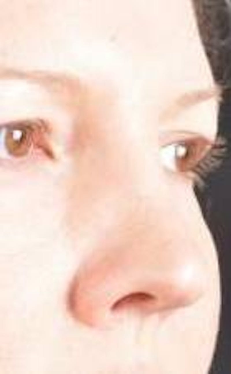 Rhinoplasty Before & After Gallery - Patient 483105 - Image 9