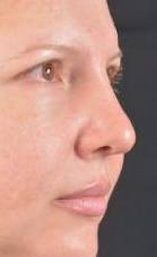 Rhinoplasty Before & After Gallery - Patient 483105 - Image 10