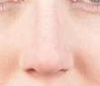 Rhinoplasty Before & After Gallery - Patient 309432 - Image 2