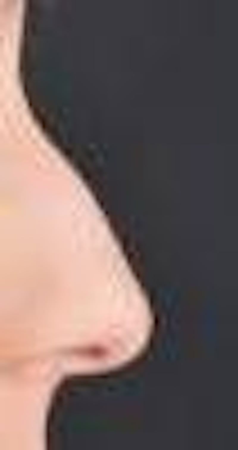 Rhinoplasty Before & After Gallery - Patient 309432 - Image 5
