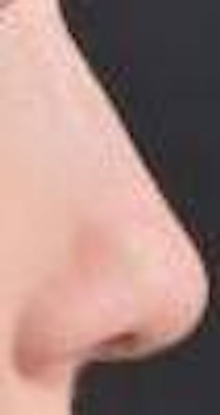 Rhinoplasty Before & After Gallery - Patient 309432 - Image 6