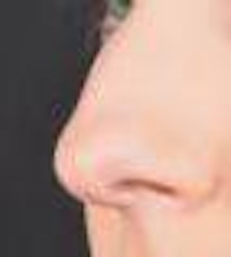 Rhinoplasty Before & After Gallery - Patient 309432 - Image 7