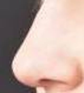 Rhinoplasty Before & After Gallery - Patient 309432 - Image 8