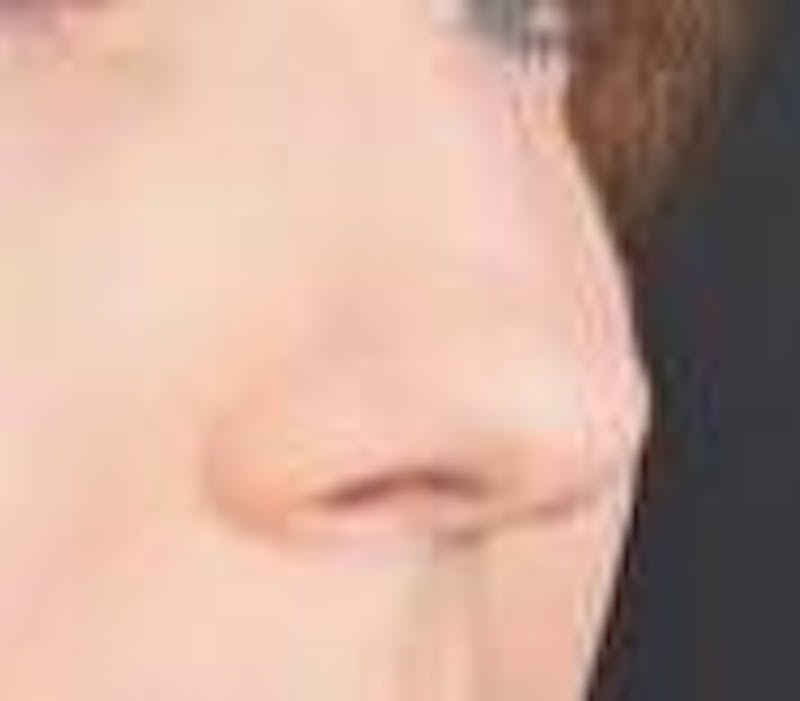 Rhinoplasty Before & After Gallery - Patient 309432 - Image 9