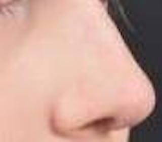 Rhinoplasty Before & After Gallery - Patient 309432 - Image 10