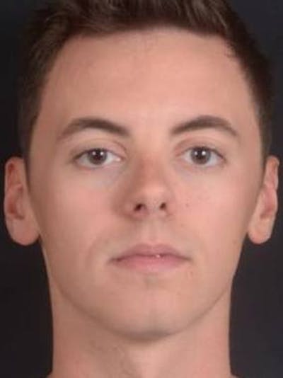 Rhinoplasty Before & After Gallery - Patient 572027 - Image 1