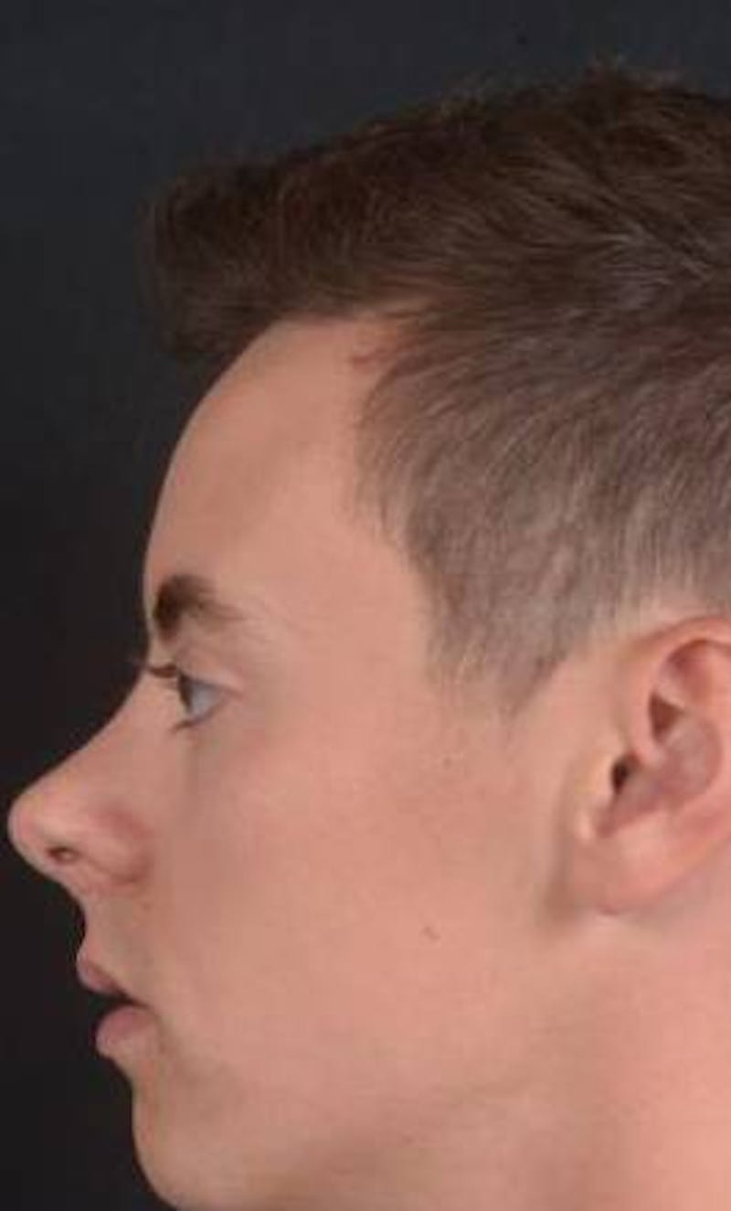 Rhinoplasty Before & After Gallery - Patient 572027 - Image 3