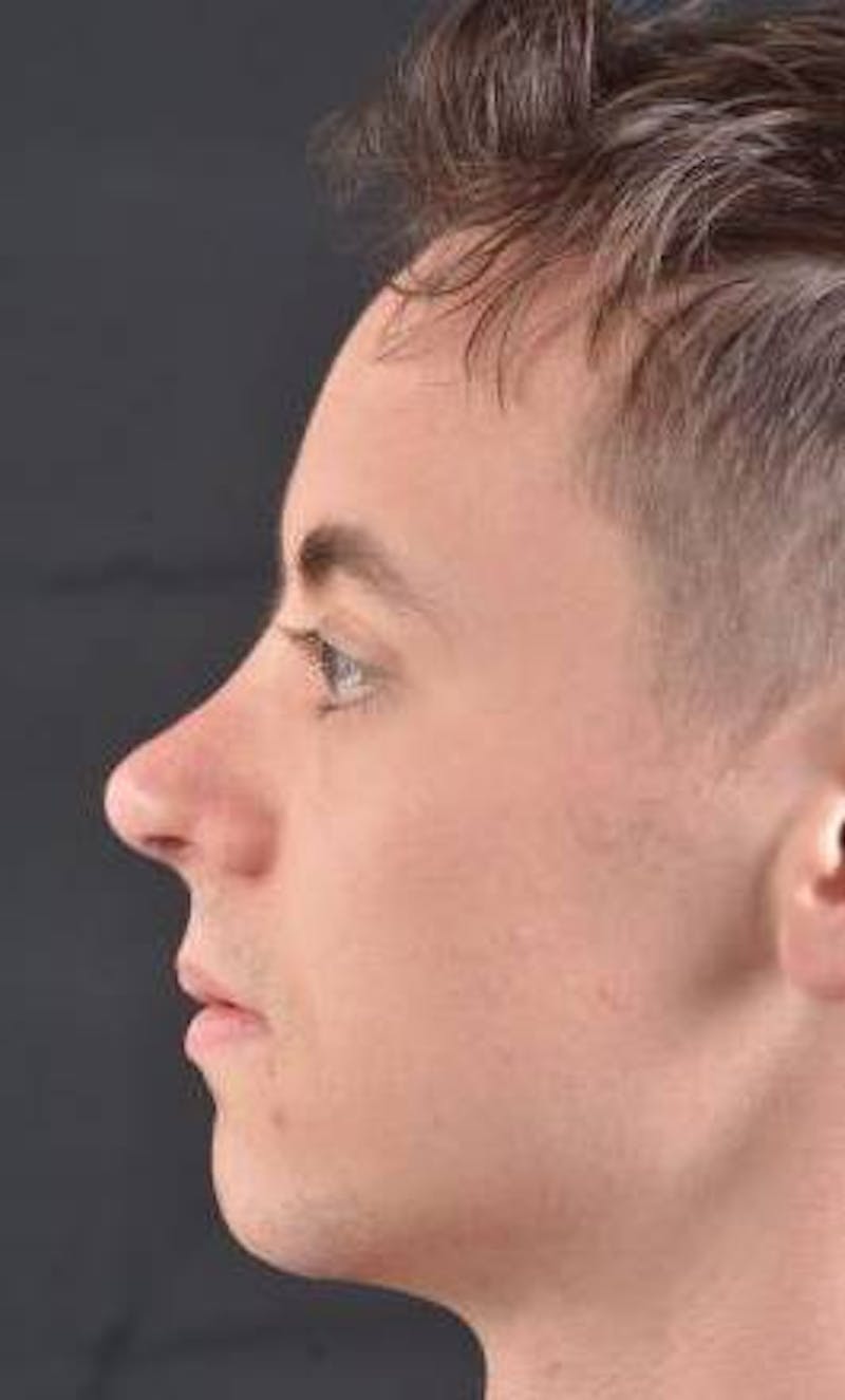 Rhinoplasty Before & After Gallery - Patient 572027 - Image 4