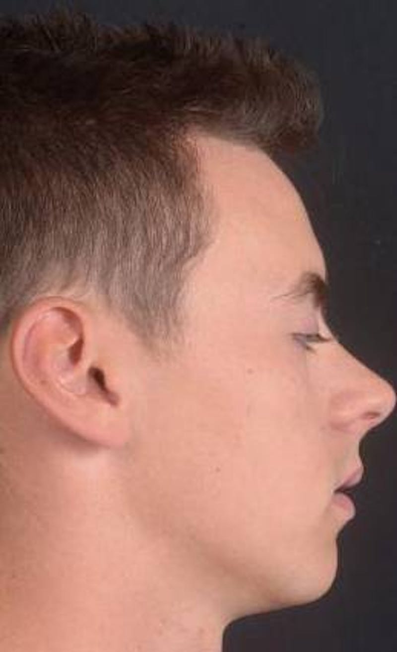 Rhinoplasty Before & After Gallery - Patient 572027 - Image 5