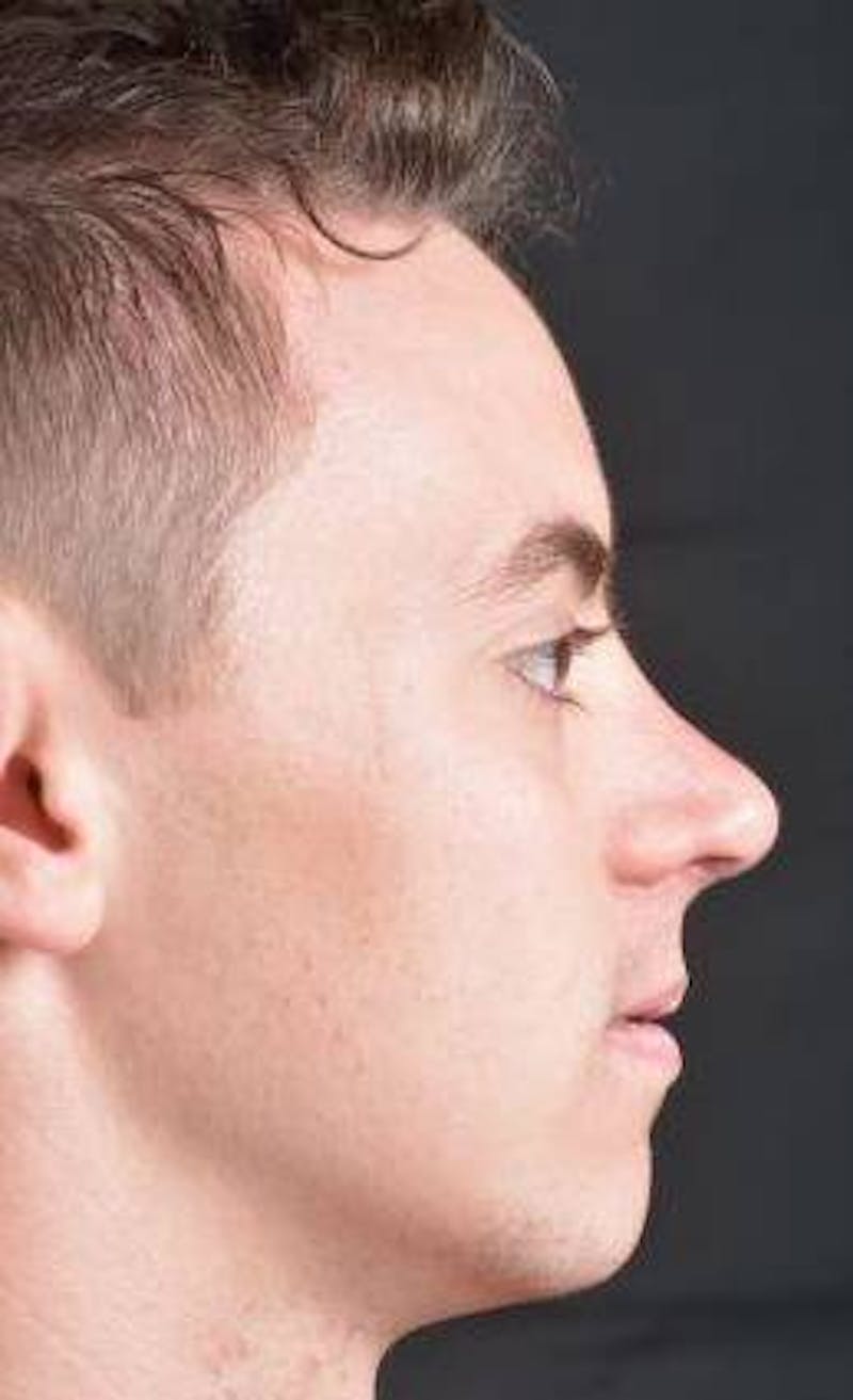 Rhinoplasty Before & After Gallery - Patient 572027 - Image 6