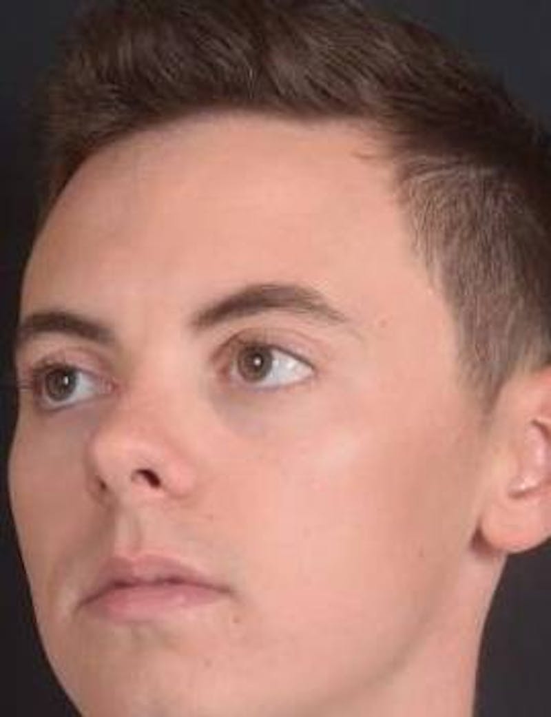 Rhinoplasty Before & After Gallery - Patient 572027 - Image 7