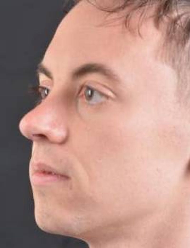 Rhinoplasty Before & After Gallery - Patient 572027 - Image 8