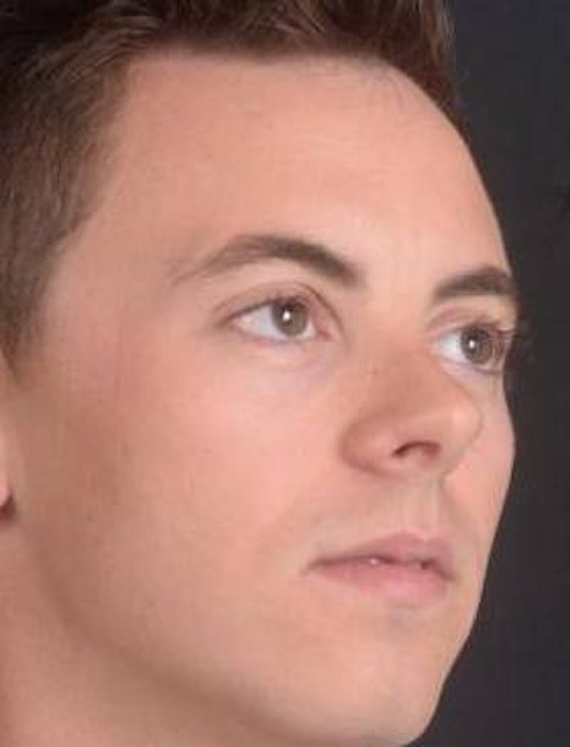 Rhinoplasty Before & After Gallery - Patient 572027 - Image 9