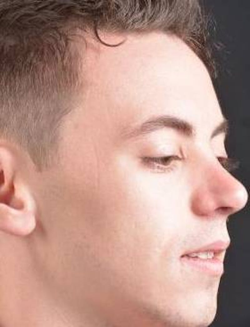 Rhinoplasty Before & After Gallery - Patient 572027 - Image 10