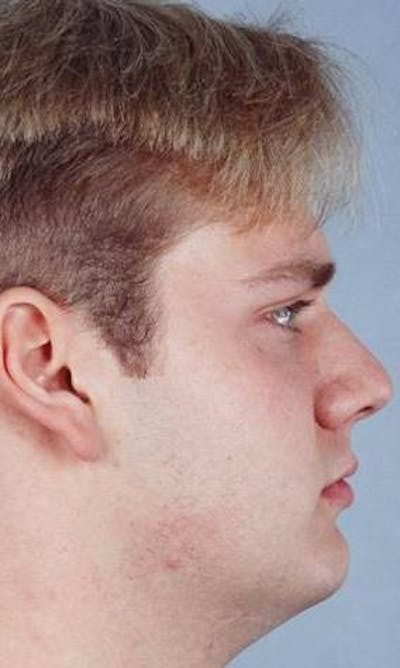 Rhinoplasty Before & After Gallery - Patient 425285 - Image 1