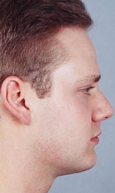 Rhinoplasty Before & After Gallery - Patient 425285 - Image 2
