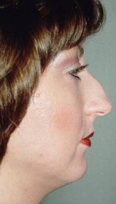 Rhinoplasty Before & After Gallery - Patient 919476 - Image 1