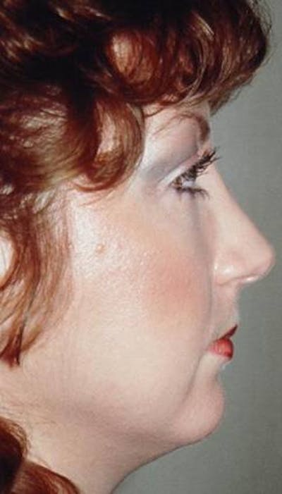 Rhinoplasty Before & After Gallery - Patient 919476 - Image 2