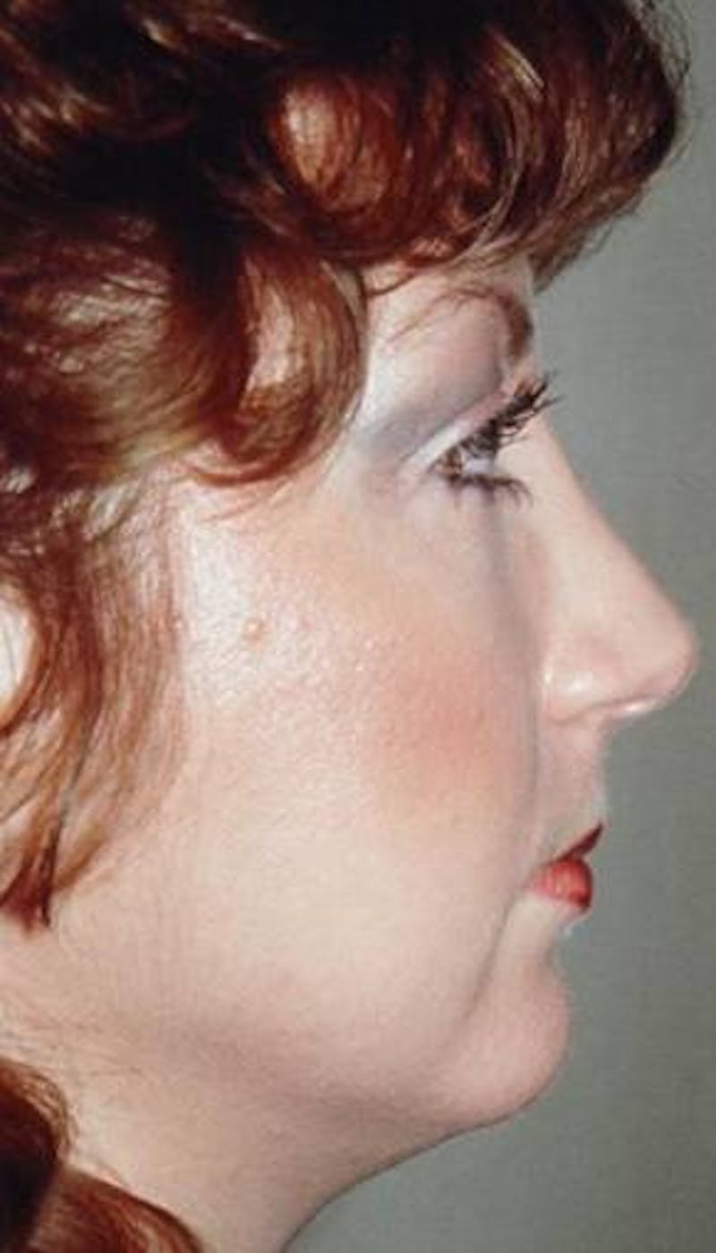 Rhinoplasty Before & After Gallery - Patient 919476 - Image 2