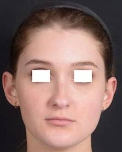 Rhinoplasty Before & After Gallery - Patient 183452 - Image 1