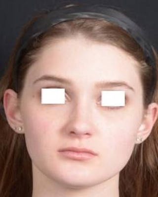 Rhinoplasty Before & After Gallery - Patient 183452 - Image 2