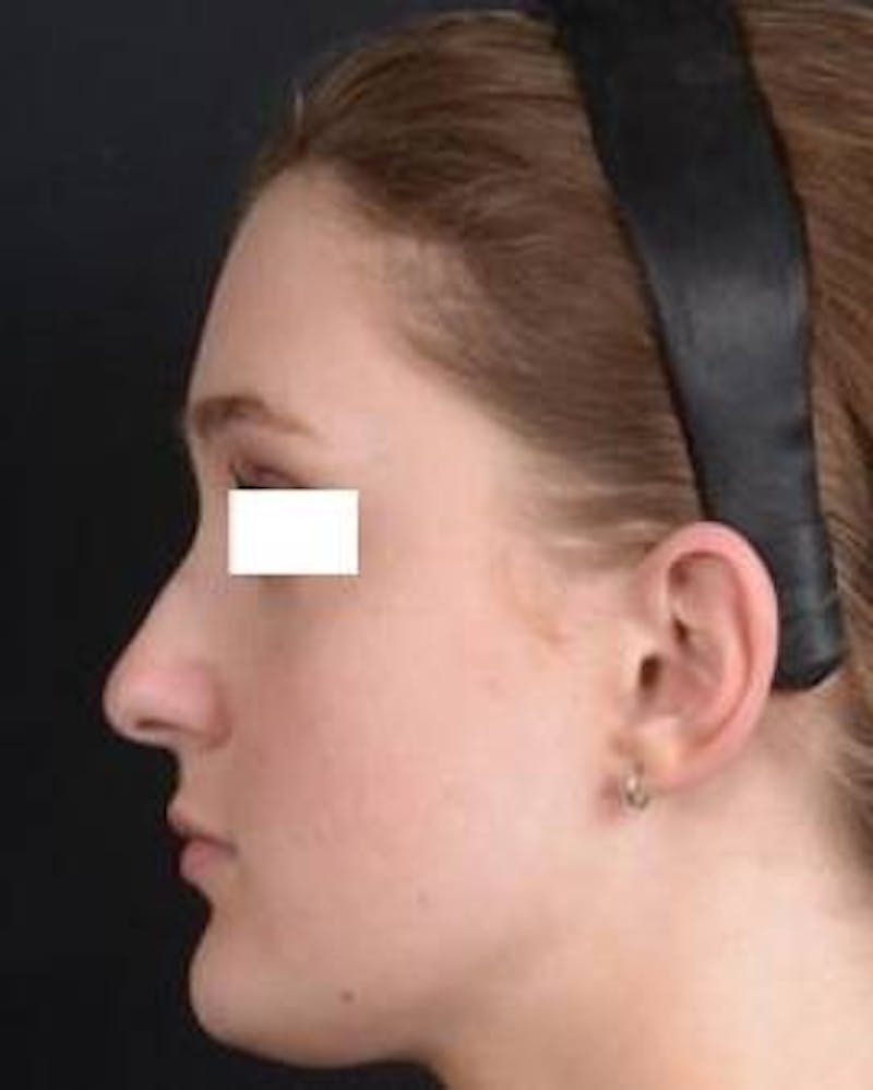 Rhinoplasty Before & After Gallery - Patient 183452 - Image 3